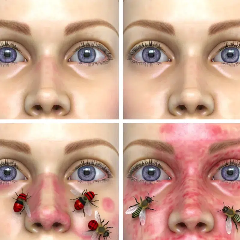 Vier Frauenaugen in den Ecken des Bildes, die die Symptome einer Allergie gegen Wimpernkleber wie Rötung und Irritation deutlich zeigen